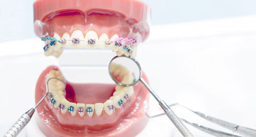 can braces fix an overbite