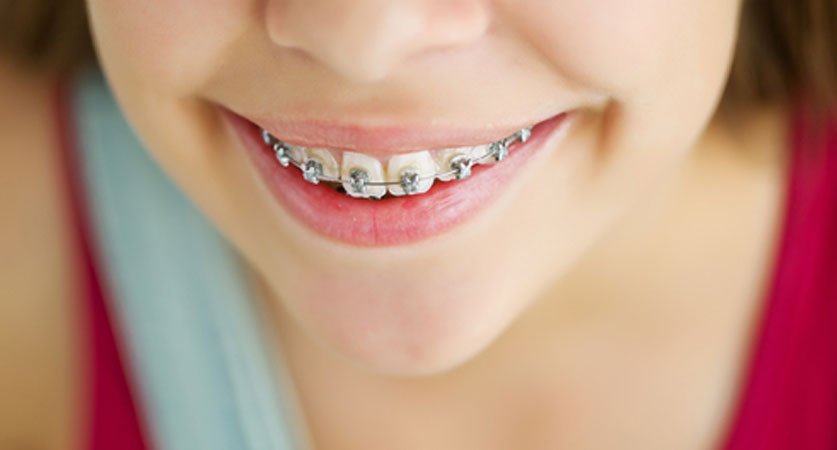 Braces For Kids