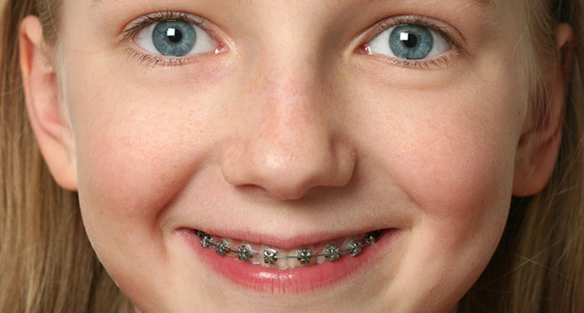 kids teeth braces