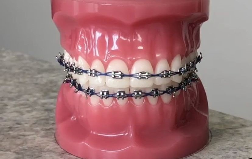 Black Braces