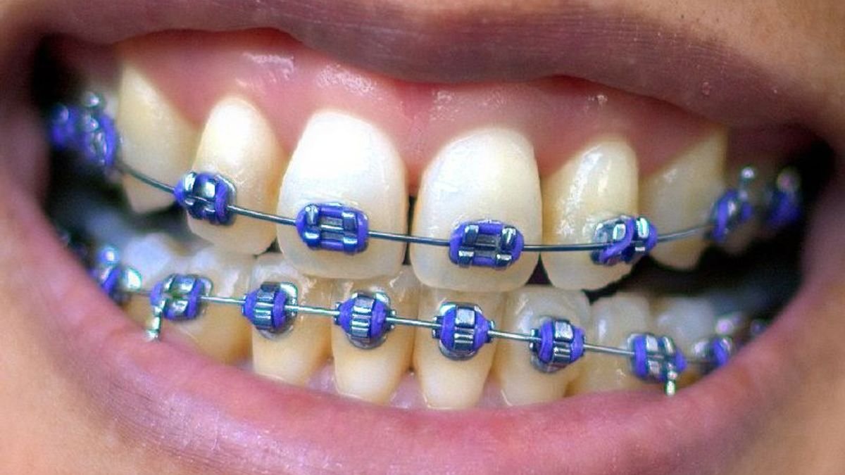 braces colors