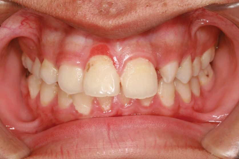 Gingivitis Treatment