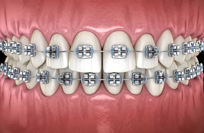 metal-braces