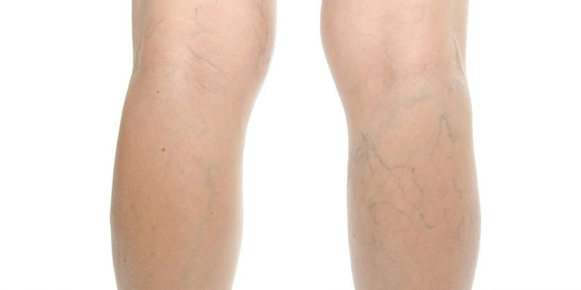 Varicose Veins