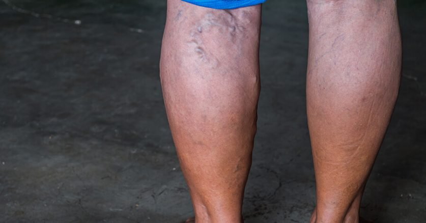 Varicose Veins