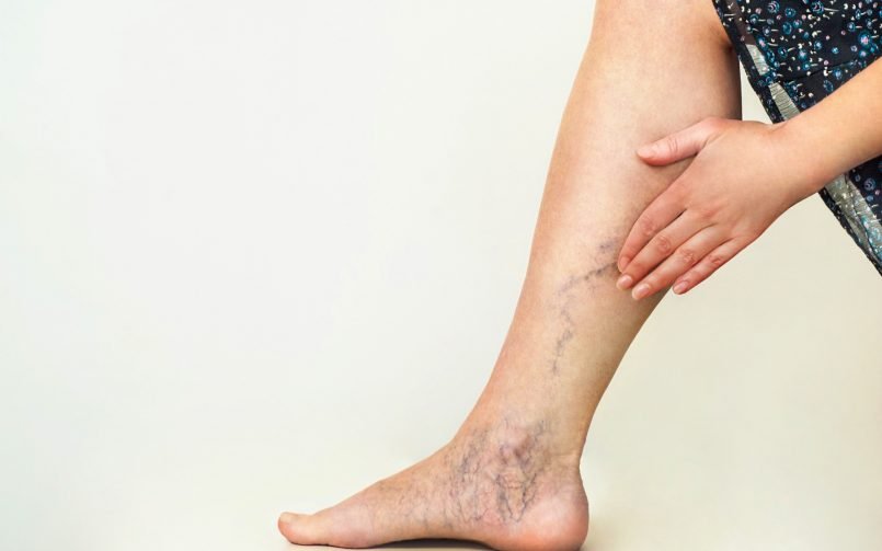 Varicose Veins