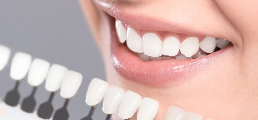 Dental veneers