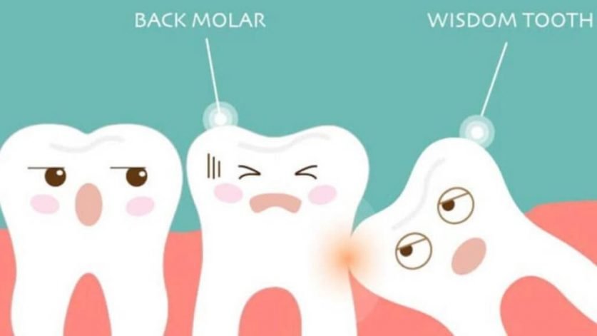 Wisdom Teeth Removal