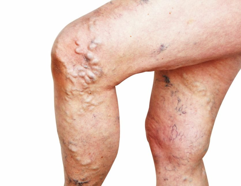 Signs Of Vein Disease