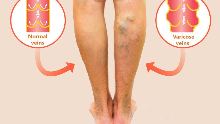 Poor Circulation in Legs