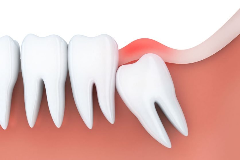 Wisdom Tooth Extraction