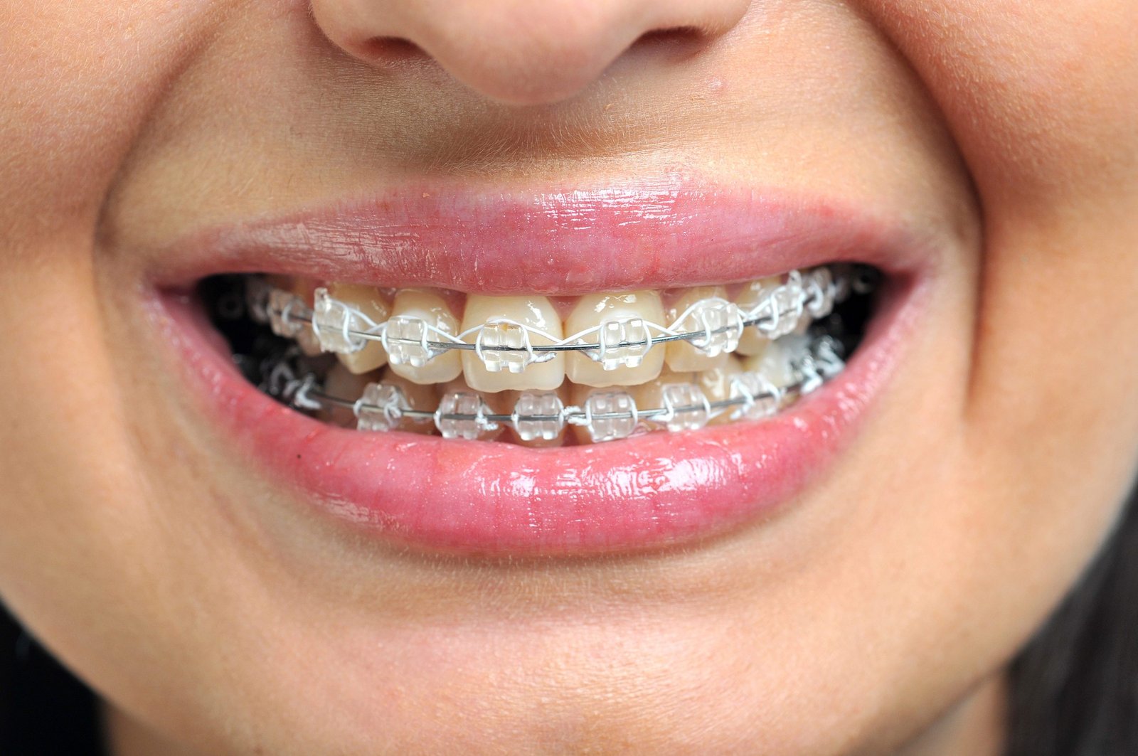 Orthodontic Braces Treatment