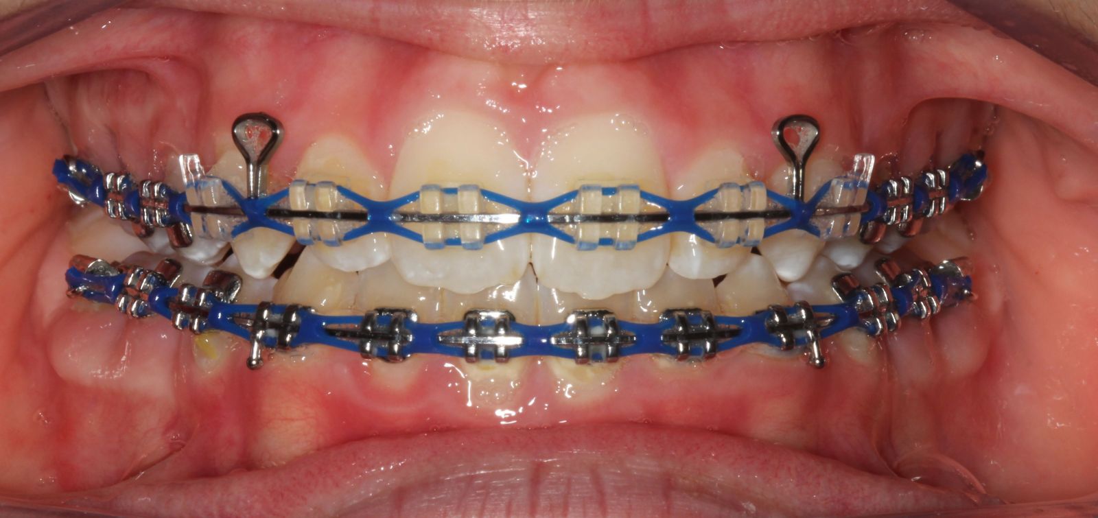dark blue braces