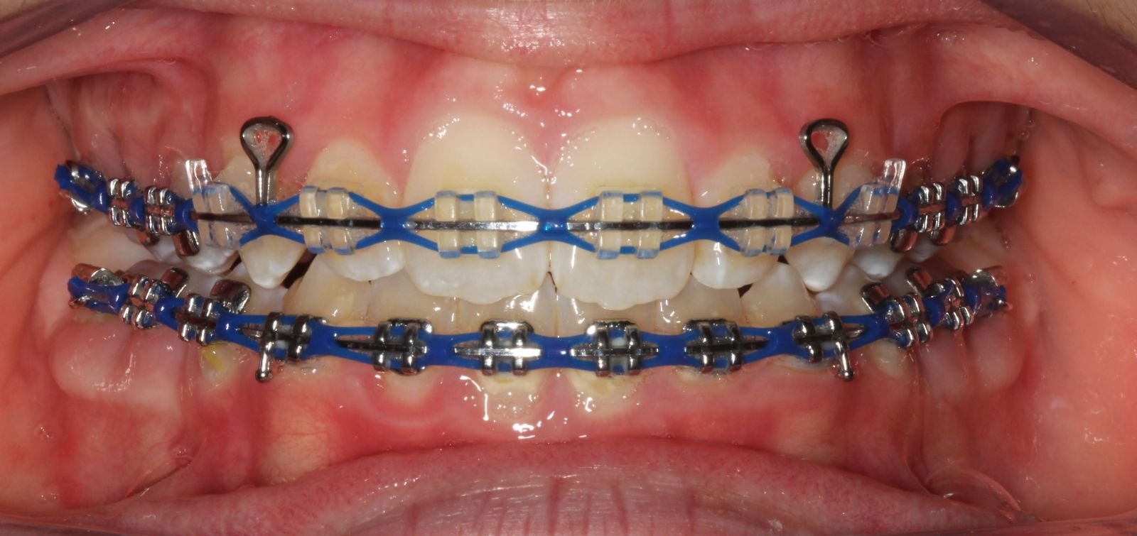 dark blue braces