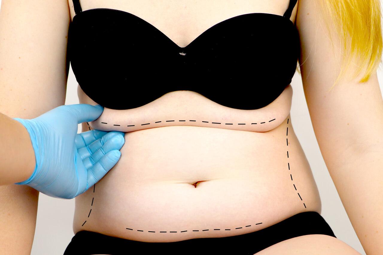 Belly Fat Removal Surgery