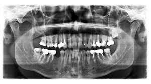 Periapical X-Ray