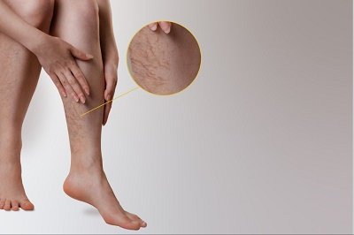 How can I get rid of varicose veins without surgery?