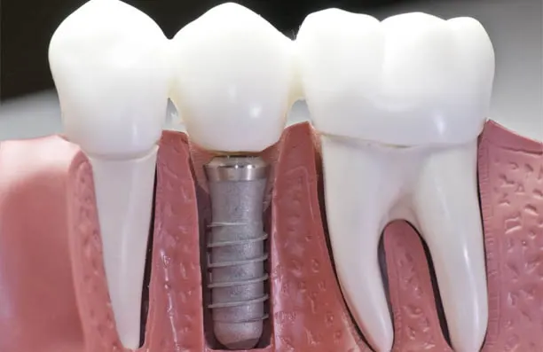 Denture Implants Cost