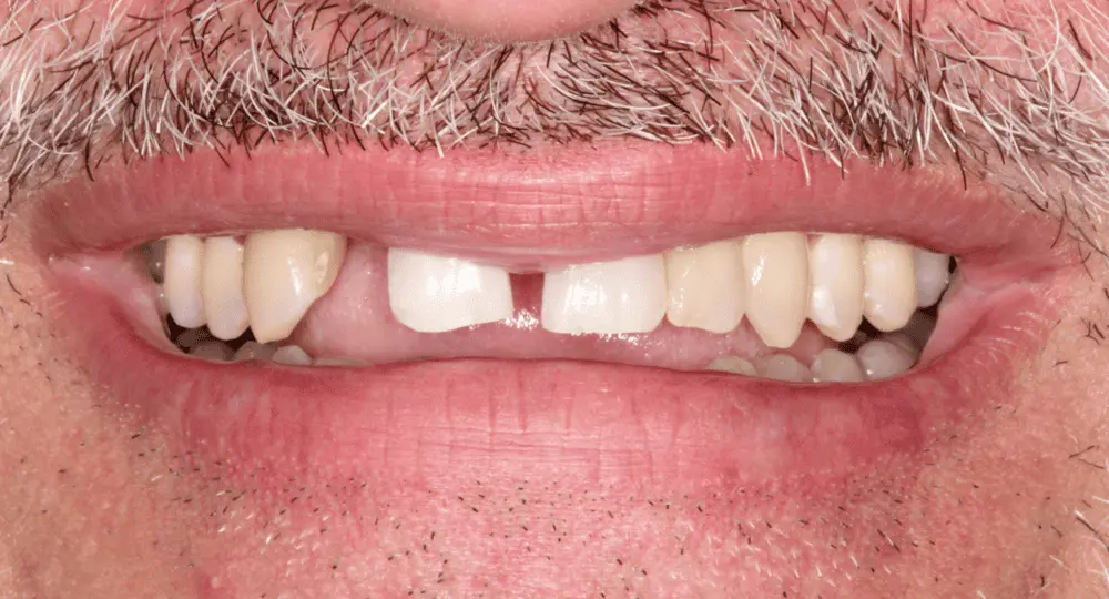 Cosmetic Dental Implants